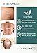 Accunex Tea Tree Oil, Salicylic Acid & Niacinimide All in 1 Acne Prevention – 100g