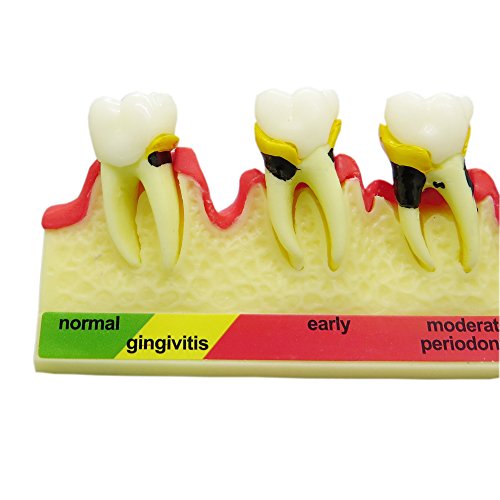 Teeth Periodontal Disease Model Dental Caries Breakdown Display Periodontitis Show Teaching Tooth Model Dentist Odontologia Communication #TOP4