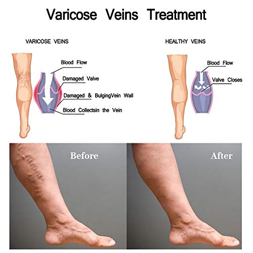 Varicose Cream, Varicose Veins Cream, Varicose Vein Treatment, Relief Phlebitis Angiitis Inflammation, Blood Vein Veins Vasculitis, Improve Blood Circulation for Treatment Legs Care