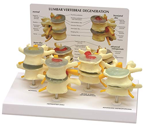 4-stage Osteoporosis Vertebrae Anatomical Model