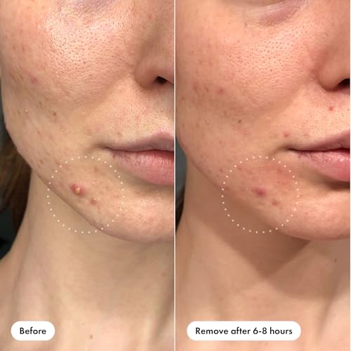 Mighty Patch™ Invisible+ Patch - Daytime Hydrocolloid Acne Pimple Patches for Covering Zits and Blemishes, Ultra Thin Spot Stickers for Face and Skin (24 Medium and 15 Small Patches) - Image 4