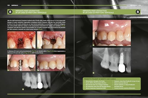 Impianti Immediati. Manuale Clinico Operativo Con Procedure Step By Step - 10