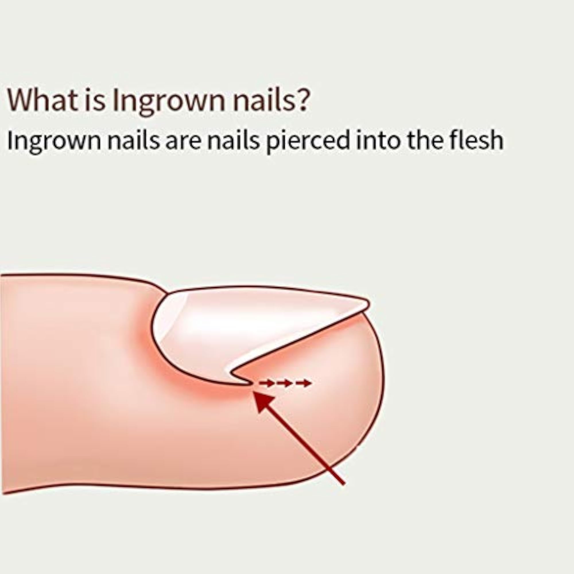 Ingrown Toenail Correction Tools, Nail Cleaner