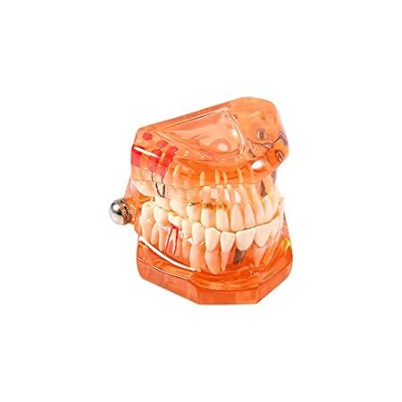 Tooth Removable Tooth Model Model Pathologies Disease Model