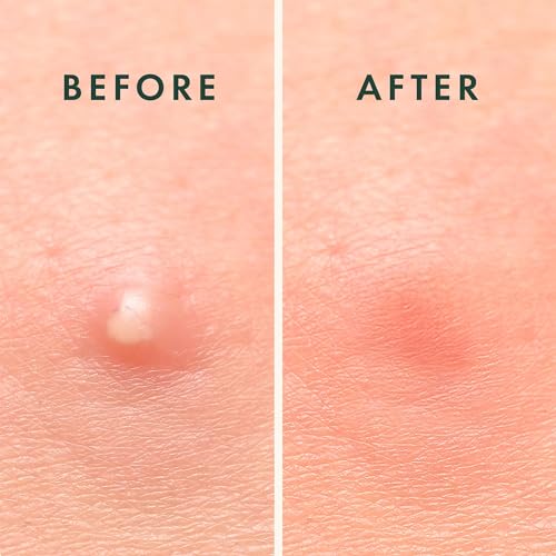 Rael Pimple Patches, Miracle Overnight Spot Cover, Korean Skincare, Hydrocolloid Acne Spot Patch, Thicker & Extra Adhesion - Image 3