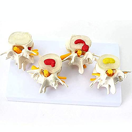 QIQIZHANG Anatomy Model, 10 Human Spine Model - Anatomical Lumbar Spine Lesion Demonstration Teaching Props Model - PVC Material for Medical Demonstration
