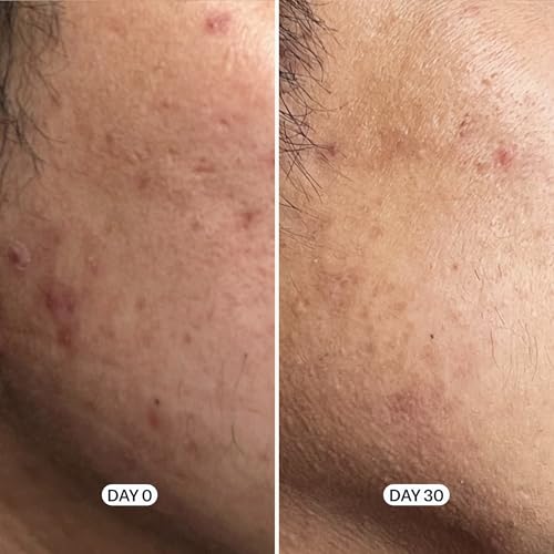Image of Geologie Skin Repair Moisturizer Face Cream | Clear System Retinol Resurfacing Formula | For Blemish Prone Skin with Niacinamide & Hyaluronic Acid | 60 ML (Pack of 2)