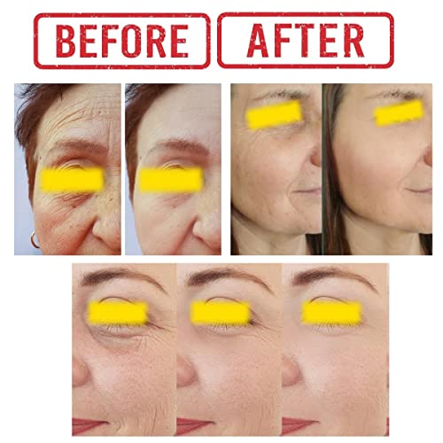 Vitamin C Under Eye Serum For Puffy Eyes Treatment, Under Eye Tightening & Eye Lifting, Dark Circles Corrector, Under Eye Bags Remover, Fine Lines, Anti Wrinkles, With Hyaluronic Acid & Kojic Acid 1 Fl Oz #TOP3