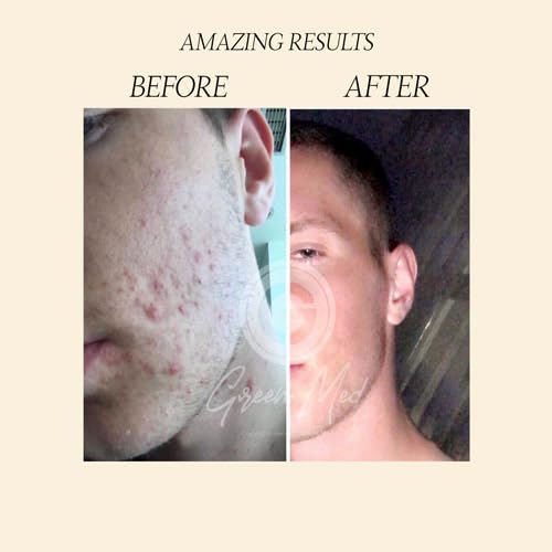 African Black Soap - Eliminate Acne | Pimples and Acne Scars | Regenerates the skin | Deep clean pores and Regenerate damaged pores | Face and Body Bar | 2.82oz Soap - Image 3