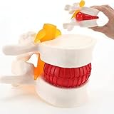 Human Anatomical Lumbar Disc Herniation Model - Lumbar Spine Model for Teaching & Learning, Life Size Lumbar Disc Herniation Model - Excellent Way for Demonstrating Disc