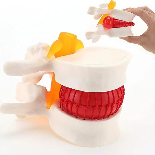Human Lumbar Disc Herniation Model for Teaching