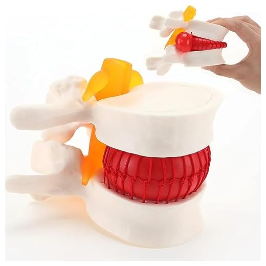 Modelo anatómico de hernia de disco lumbar
