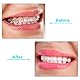 20 Stück Aligner Tablett Sitzer für Aligner Tabletts Chompers Aligner Tabletts