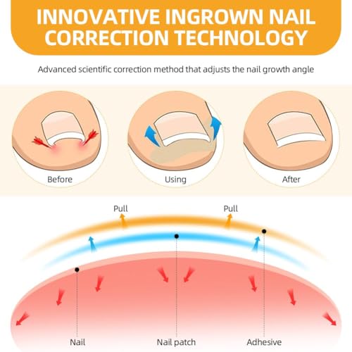 Image of 101 /190pcs Ingrown Toe Nail Remover, Toenail Corrector Strips and Ingrown Toenail Correction Tool, for Daily Nail Care and Post-Exercise Maintenance (190PCS Brown)