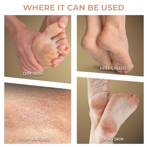 Winston Callus Remover for Feet Electronic Foot Scrubber for Dead Skin, Electric Pedicure Machine for Food Scrubber - 120 Min - Image 3