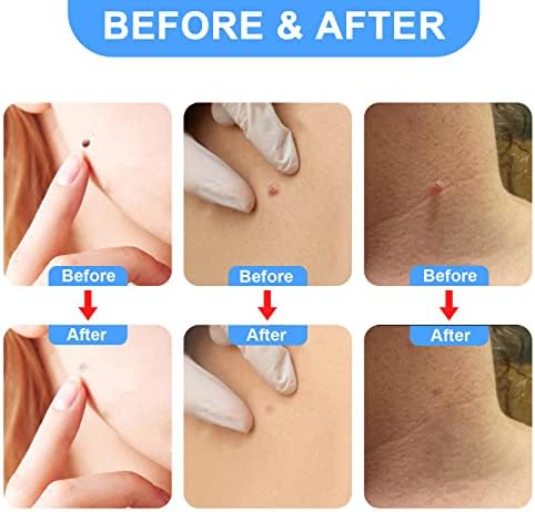 Skin Tag Remover, WANDiORY Skin Tag Removal Kit for Small to Medium 2-5mm Skin Tags (40x Removal Bands, 36 Repair Patches, 10 Cleansing Wipes), Easy to Use, Safe and Painless