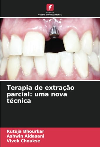 Terapia de extração parcial: uma nova técnica (Portuguese Edition)