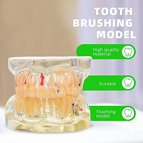 DOITOOL Tandheelkundig implantaat Tanden Model Transparante Volwassen Pathologieën Implantaat Demonstratie Tanden… - Image 8