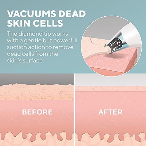 Revitalisation de la peau par micro-dermabrasion rides - 5