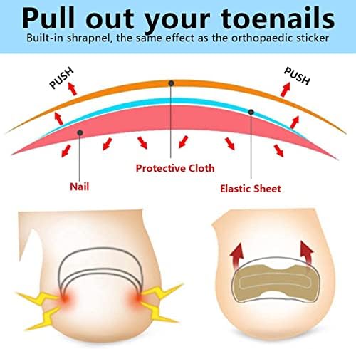 Ingrown Toenail Correction Patch Ingrown Toenail Sticker Patch 50PCS Nail Correction Sticker with 4PCS Nail Correction Tool,Glue-Free Toenail Correction Patch for Ingrown Toenails Foot Care Treatment