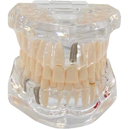 Modèle dentaire de restauration Hrippy pour comprendre l'implant