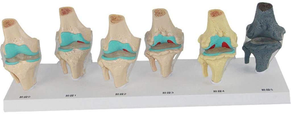 Modèle de blessure au Genou en 6 étapes - Le Genou modèle Anatomique Joint - Affichage de la Science de l'étude en Classe avec des modèles de Rubans et de matériel médical