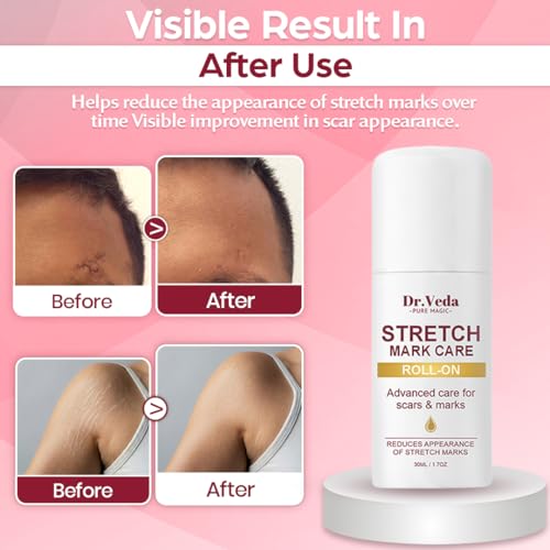 Image of Dr. Veda Stretch Mark Care Roll-On for Women - Skin Repair & Elasticity Booster with Green Tea & Licorice for Stretch Marks, Scars & Smooth Skin | 100% Natural Formula, 30 ml each Pack of 2