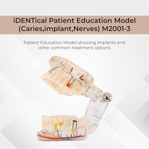 Image of iDENTical Patient Education Model (Caries, Implant, Nerves) M2001-3 | 3D Model | Featuring More than 30 Clinical Findings | Illustrative | Durable | Portable