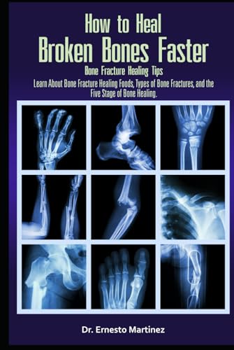 How to Heal Broken Bones Faster. Bone Fracture Healing Tips: Learn About Bone Fracture Healing...