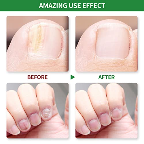 Orientleaf Nail Repair, Fingernail And Toenail Repair, Strengthen Nail Solution, Repairs And Protects Toenail And Fingernail From Discoloration, Brittle And Crack #TOP4