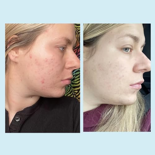 Salicylic Gel Chemical Peel - Enhanced with Green Tea Extract and Tea Tree Oil (20% Strength) - Thumbnail 7