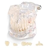 Photo Gallery uadme modello impianti dentali, modello denti dimostrativo trasparente, modello dentale di riparazione neurale rimovibili, per scuole di odontoiatria e cliniche odontoiatriche Photo Gallery uadme modello impianti dentali, modello denti dimostrativo trasparente, modello dentale di riparazione neurale rimovibili, per scuole di odontoiatria e cliniche odontoiatriche