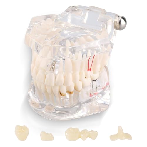 Uadme Fantoma Dental, Modelo de Demostración Dental, Modelos de Dentadura Articulada, Modelo de Dientes Desmontable, para Enseñanza Dental, Cuidado Bucal