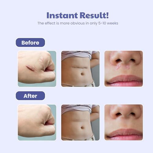 Image of Wipness Silicone Scar Sheets 61 inches (1.6 Meters) - Reusable & Flexible Medical Grade Tape for Surgical, C-Section, Burn, Acne, Keloid, Tummy Tuck & Hypertrophic Scar Removal Tape