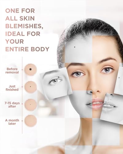 Image of Skin Tag Remover - Skin Tag and Mole Remover for Home Use, Portable Removal Kit for Mole, Wart and Skin Tag for Women and Girls