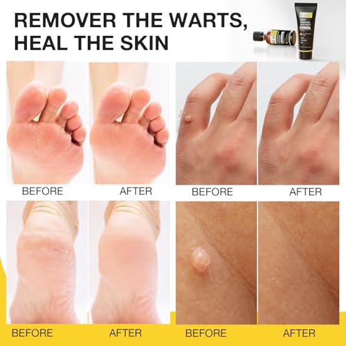 Image of MEOLY Plantar Wart Remover Set: Maximum Strength Salicylic Acid Plantar Wart Remover 12 Thick Cushioning Pads