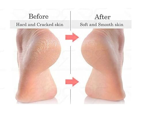 Foot Callus Cutter Razor Cuticle Hard Dead Skin Feet Hands Care Corn Remover Heel Shaver Best Pedicure Tool Plastic Handle With 10 Free Slices Blades For Men & Women #TOP2