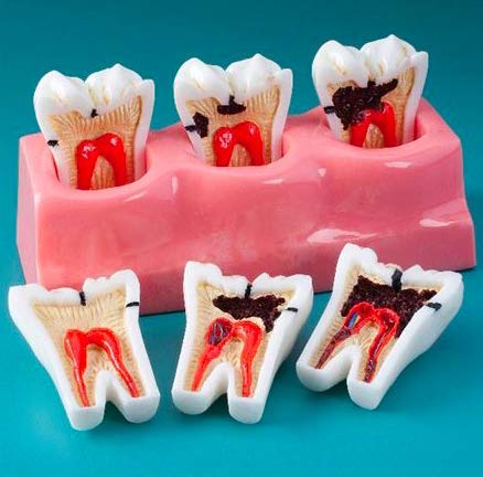 Dental Anatomical Model, 4 Times Life Size, with Removable Tooth and Caries
