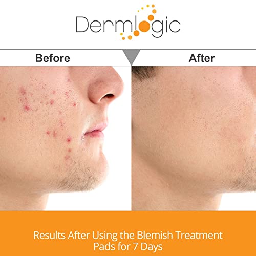 Acne Treatment Control Pads- Contains Salicylic, Glycolic, & Lactic Acid For Face & Body. Clears Away Clogged Pores, Oily Skin & Cystic Breakouts. Removes Dark Spots, Blackhead & Whitehead Pimples #TOP4