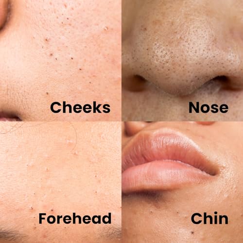 Image of Midazzle Round Blackhead & Whitehead Remover Tool, Stainless Steel Pimple & Acne Extractor Tool for Clean Pores & Clear Skin | Face Care Tool for Men & Women, All Skin Types (MIBR3301)