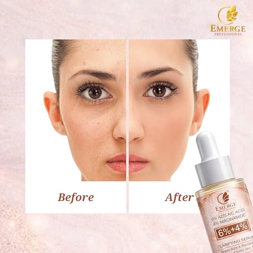 Image of 6% Azelaic Acid + 4% Niacinamide Clarifying Face Serum for Acne & Blemish Control, Brightening & Even Skin Tone - 30 ml