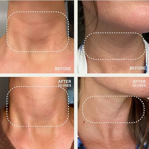 Dermaclara Neck Wrinkle Patches-Silicone Neck Patches for Wrinkles, Anti Aging and Tightening Overnight Skin Treatment for Women and Men, Anti-Wrinkle Pads,Reusable 30 Times-1 Patch (Neck Patches)
