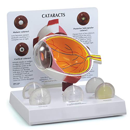 Cataract Eye Model | Human Body Anatomy Replica of Eye w Cataract Conditions for Doctors Office Educational Tool | GPI Anatomicals
