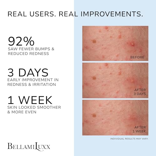 Image of BellamiLuxx Folliculitis Treatment Lotion for Body, Scalp, Face - Helps Reduce Body Acne, Itch, Redness & Bumps with Salicylic Acid & Glycolic Acid - Daily Care for Folliculitis-Prone Skin