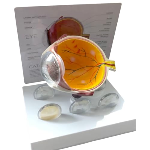 Modèle d'anatomie oculaire pour simplifier les cas cliniques complexes - 4