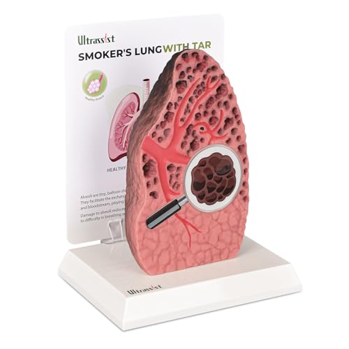 Image of Ultrassist Smoking Lung Model with Tar Damage, Lung Anatomy Model for Smoking Education