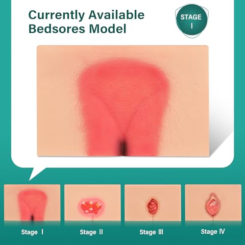 Image of Decubitus Ulcer Wound Care Model, Bedsores Model
