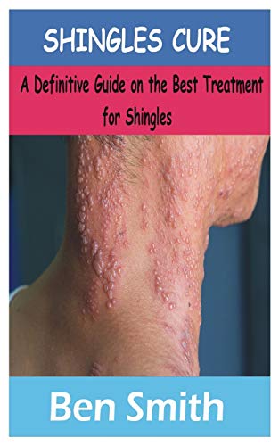 SHINGLES CURE: A Definitive Guide on the best treatment for shingles