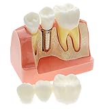 puente dental precio colombia ➤ Aplicación: gran elección para dentistas que estudian, enseñan, investigan y utilizan el laboratorio dental. Estructura flexible para facilitar la comunicación y la comprensión. Una gran elección para ti.