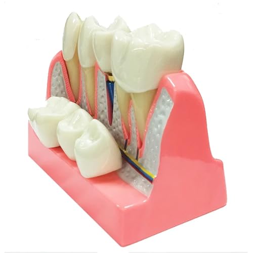 Rwbatt DM625 4 Times Dental Implant Model With Removable Crown Bridge Dental Veneers Porcelain Teeth thumb #3